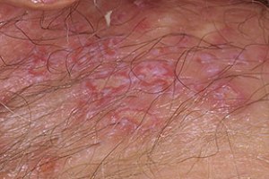 (GENITAL HERPES ) تبخال دستگاه تناسلی